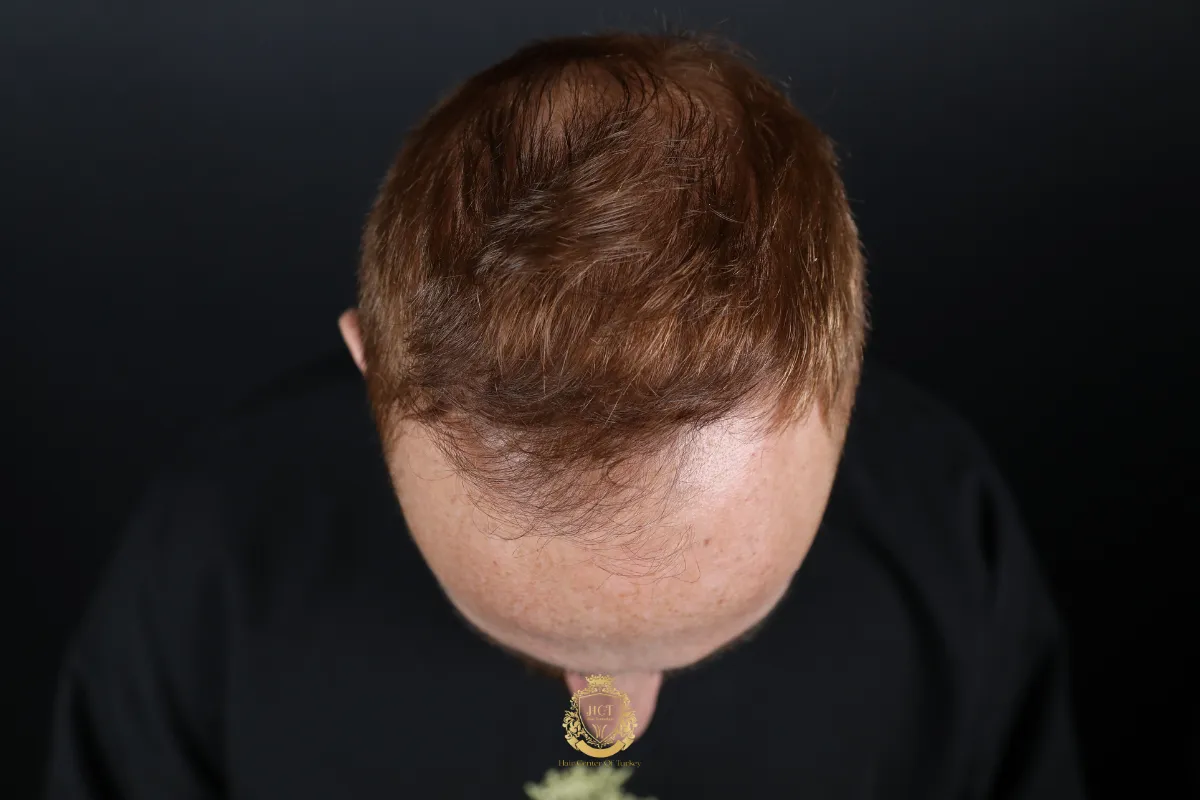 hair loss in shower