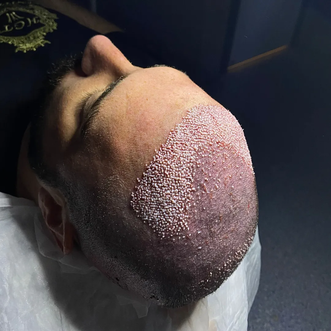 hair transplant after operation