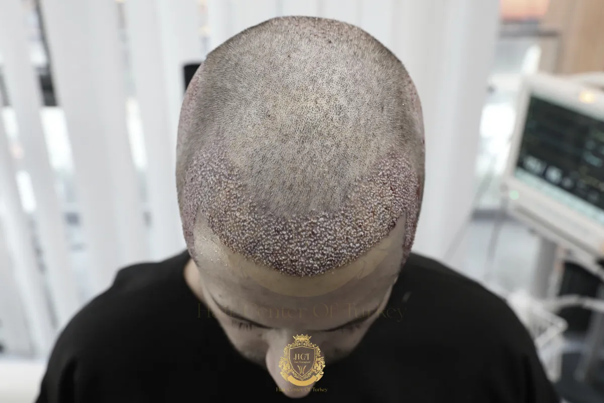 how to cope a hair transplant trypophobia 