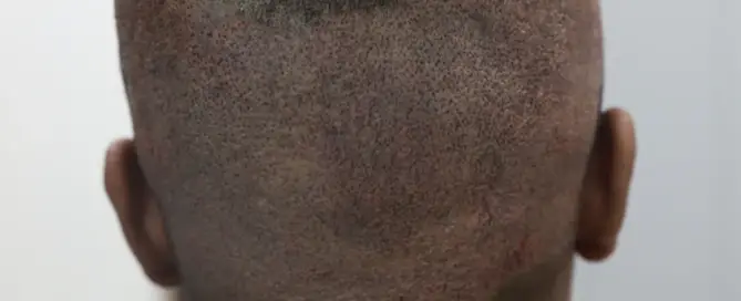 how to cope a hair transplant trypophobia