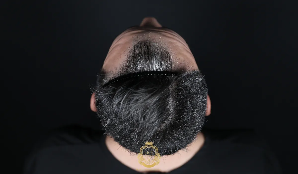 Widow’s Peak Hairline