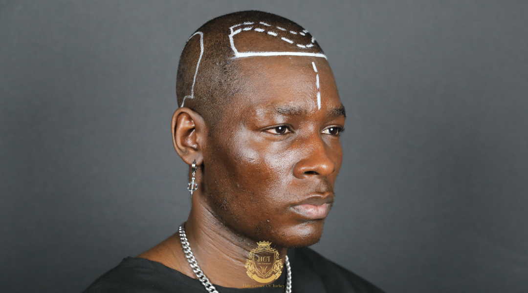 afro hair transplant hairline design