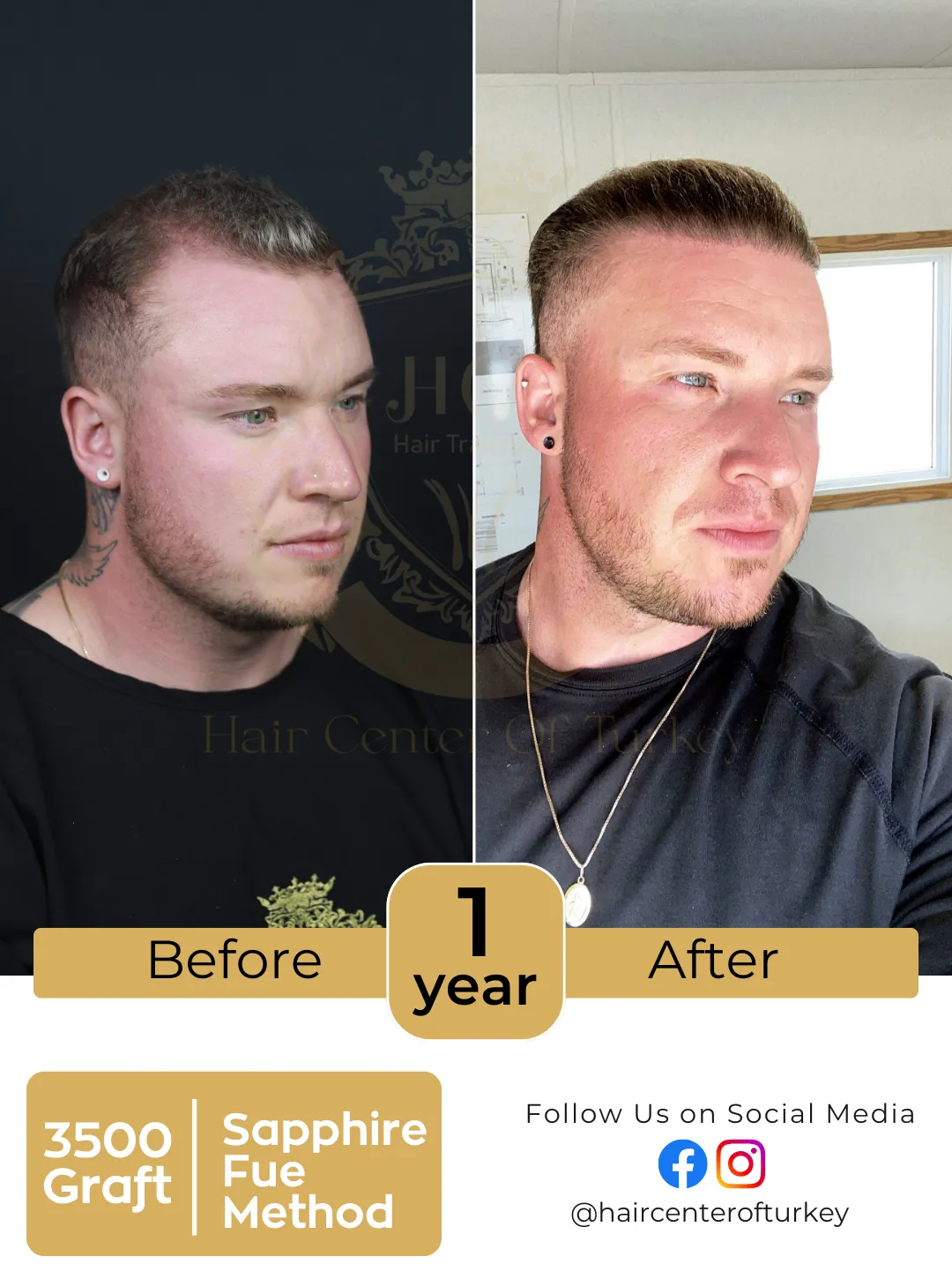 hair transplant before and after images hair center of turkey