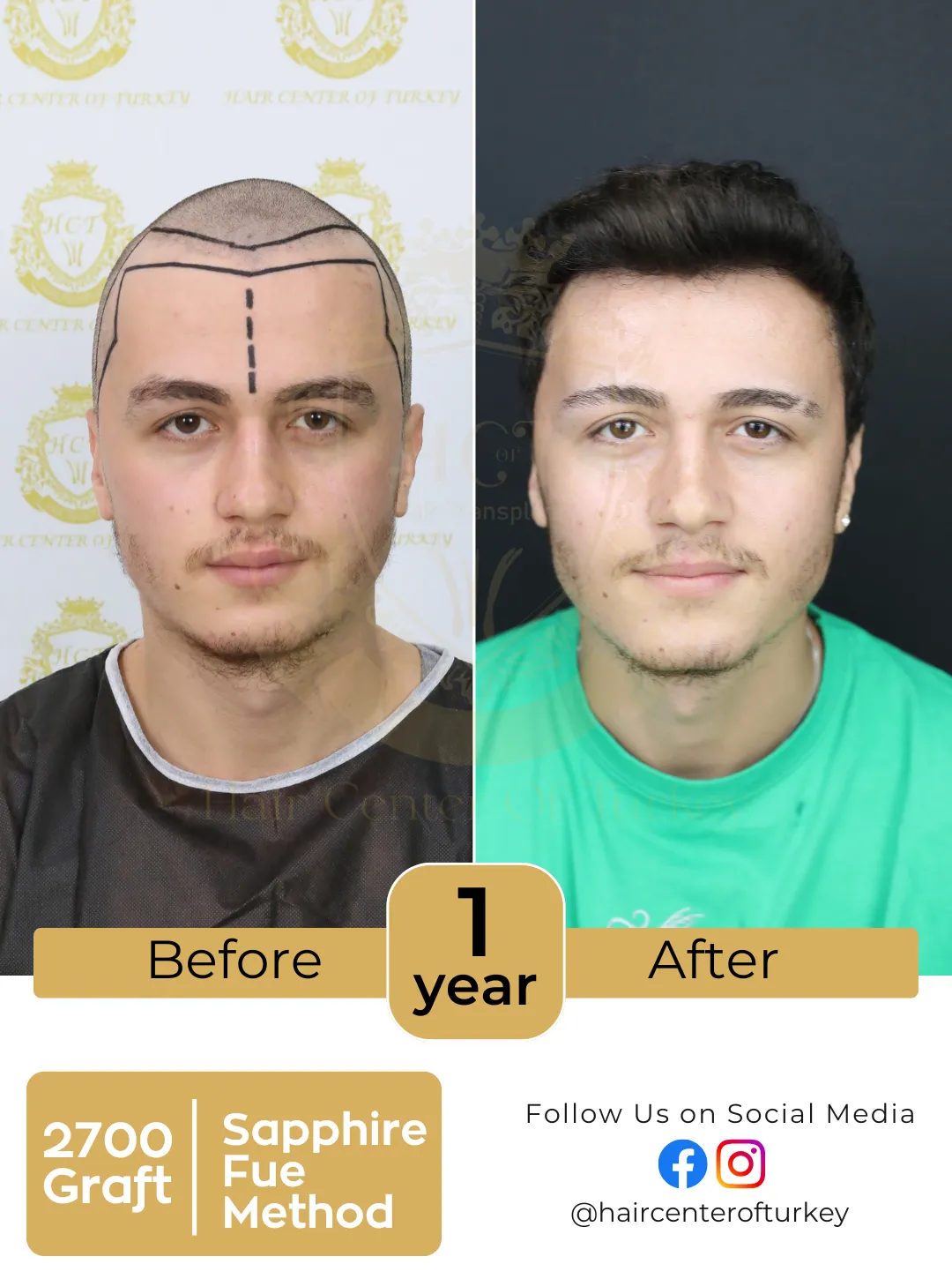 hair transplant before and after images hair center of turkey