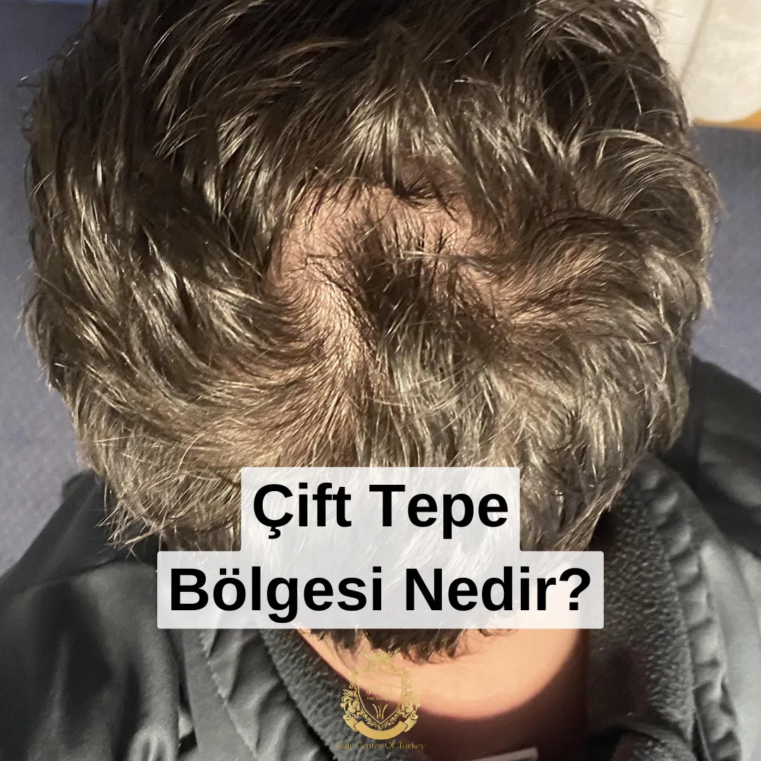 cift tepe bolgesi nedir