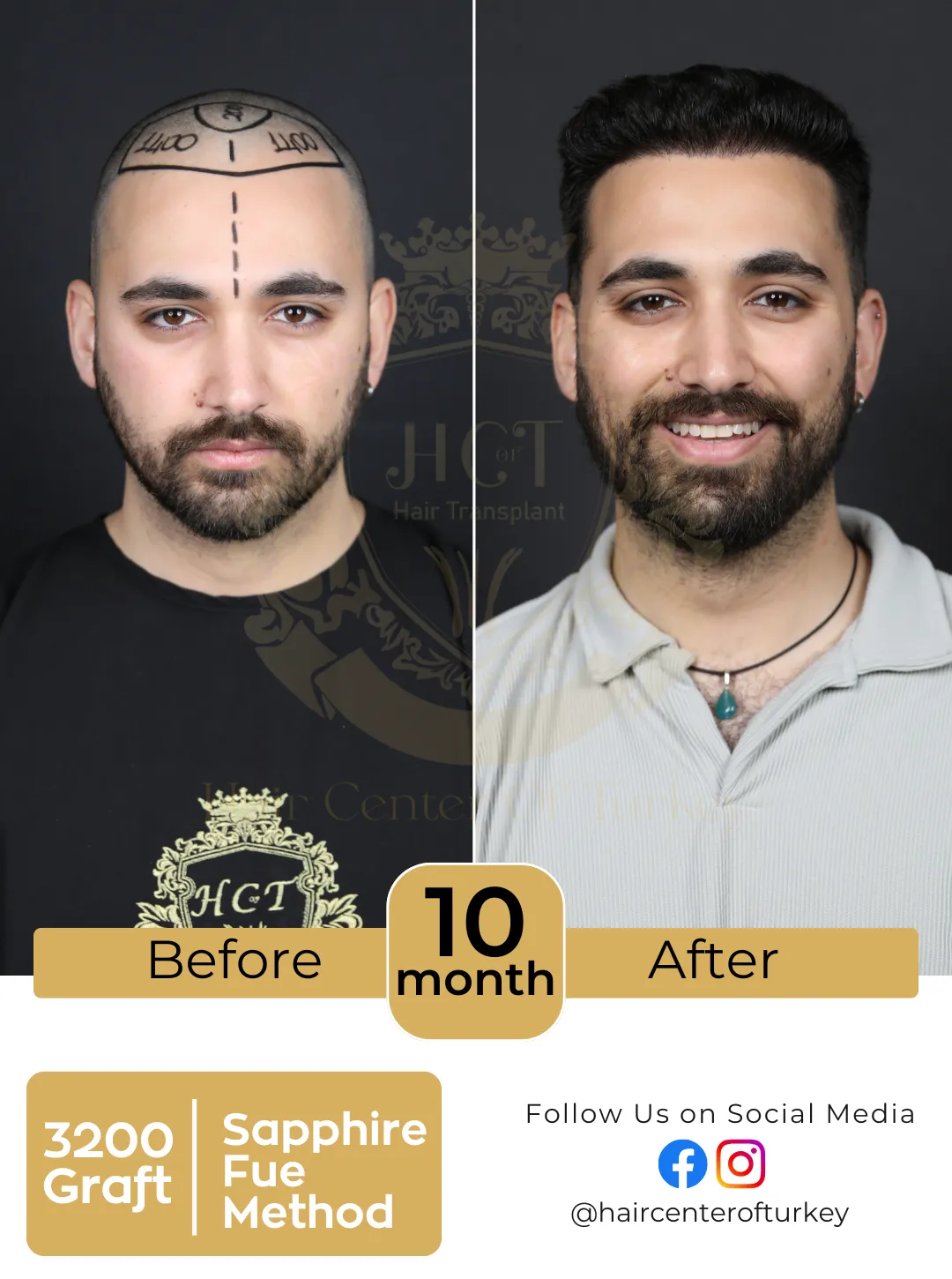 hair transplant before and after images hair center of turkey