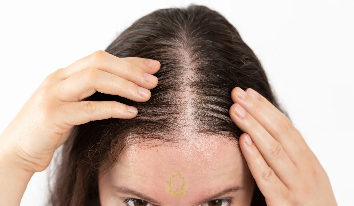 frontal fibrosing alopecia