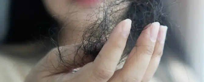 frontal fibrosing alopecia