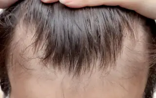 hair loss types