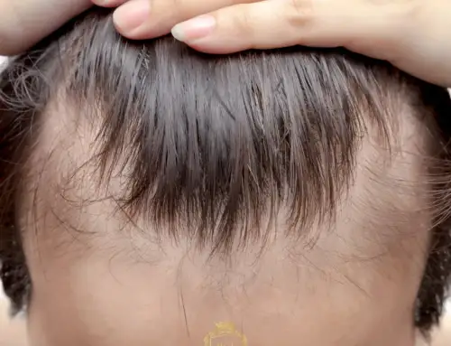 Diferentes tipos de calvicie