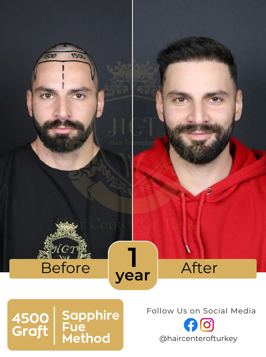 hair transplant before and after images hair center of turkey