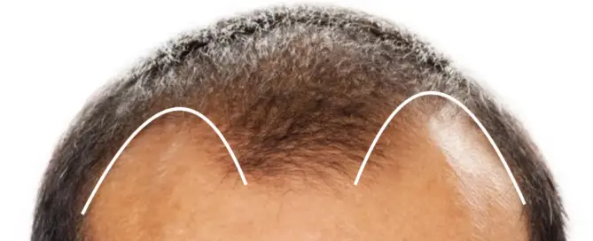 m shape hairline