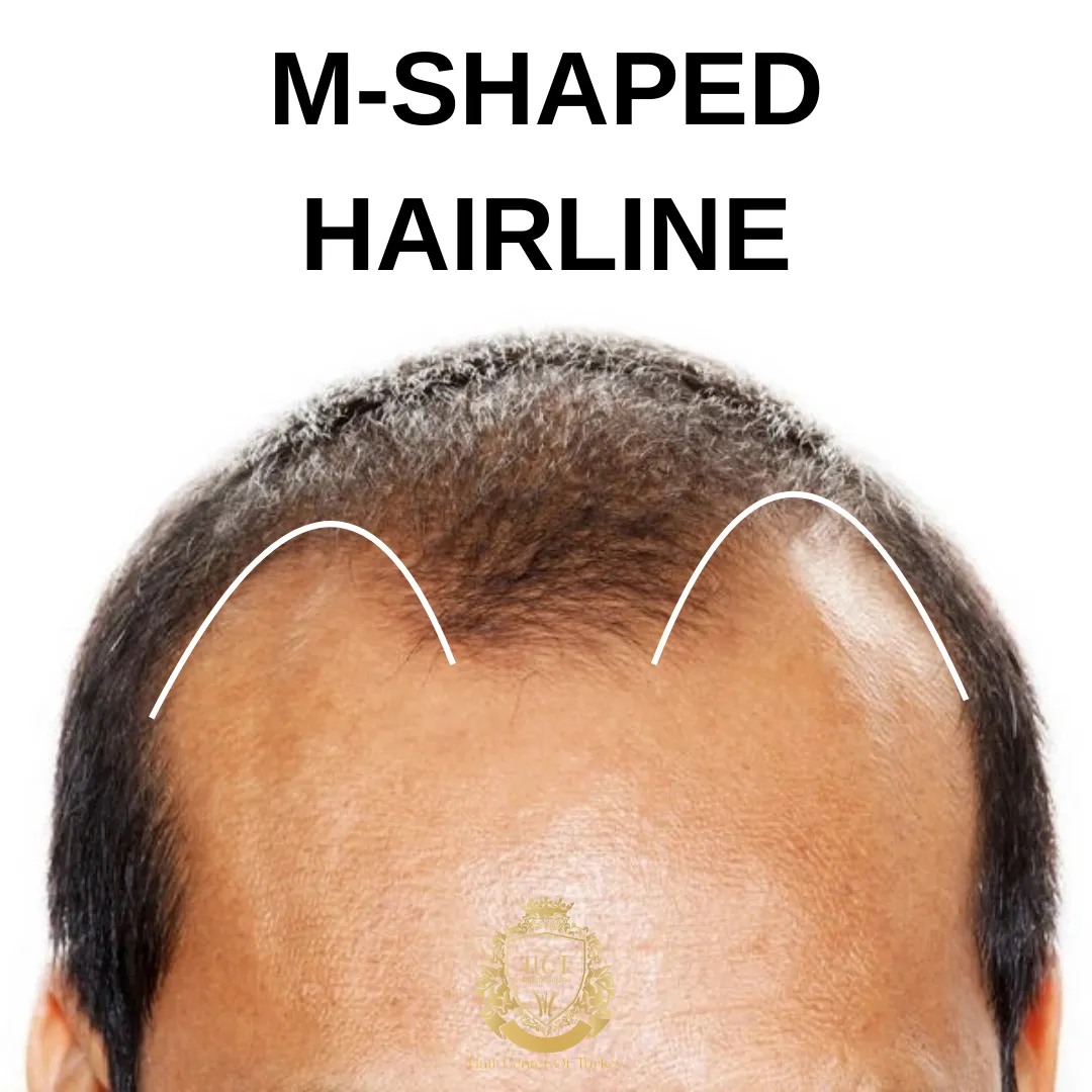 m shape hairline