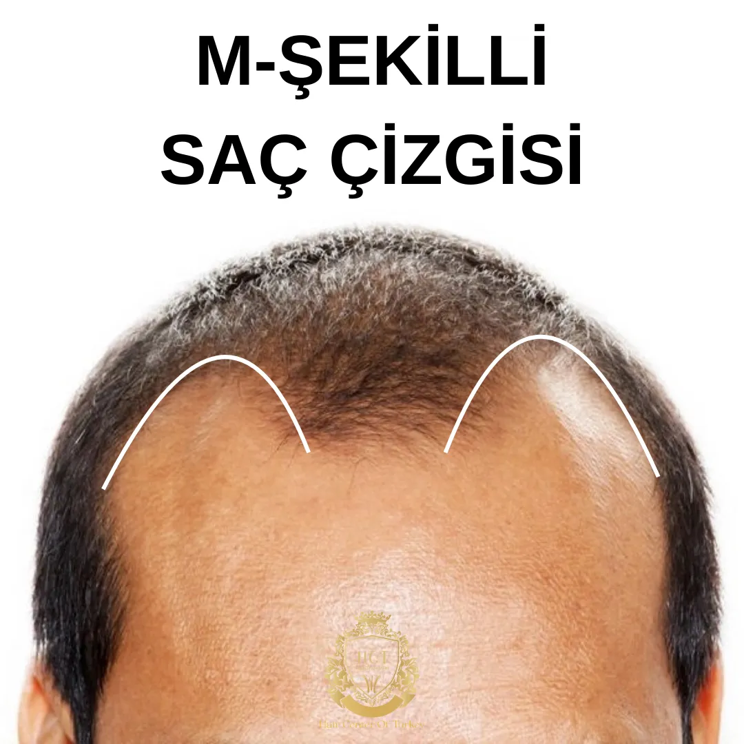 m şekilli saç çizgisi