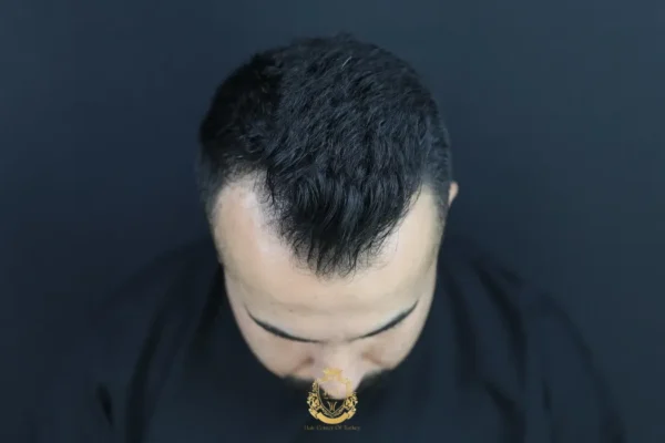 O que é uma linha capilar em forma de M?