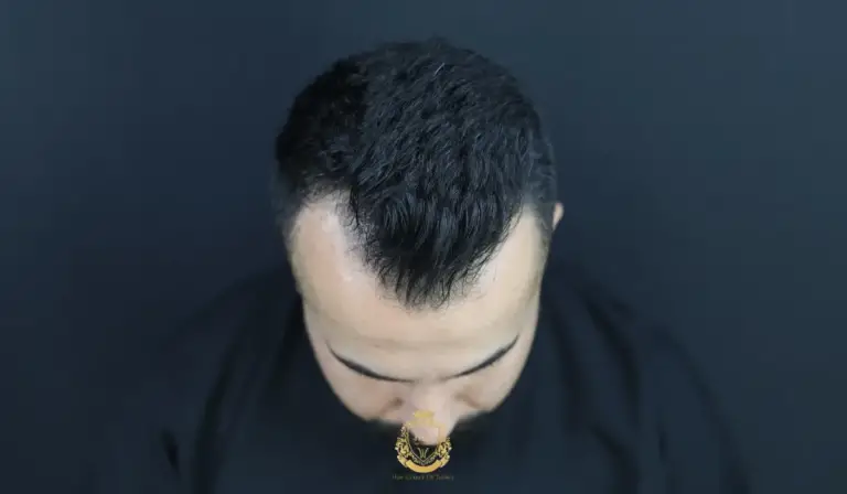 What Is an M-Shaped Hairline?