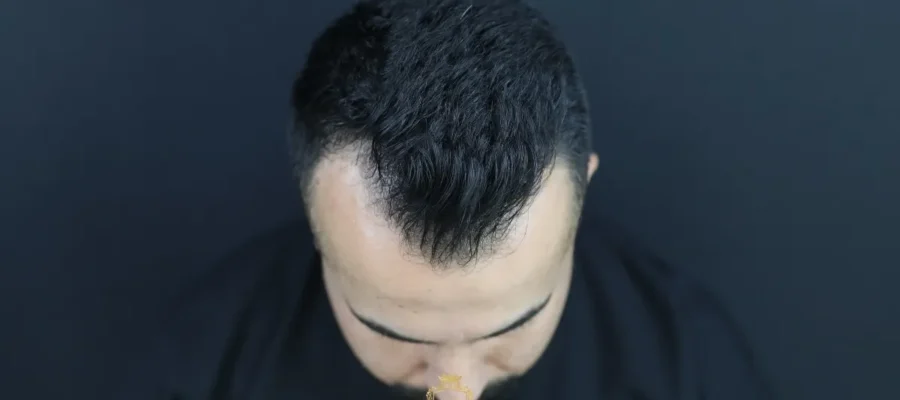 O que é uma linha capilar em forma de M?