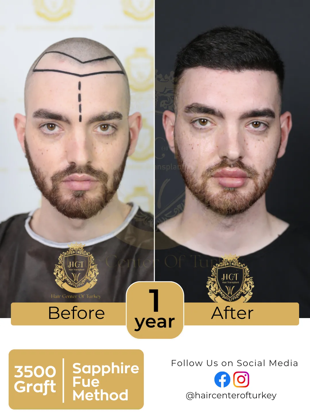 hair transplant before and after images hair center of turkey