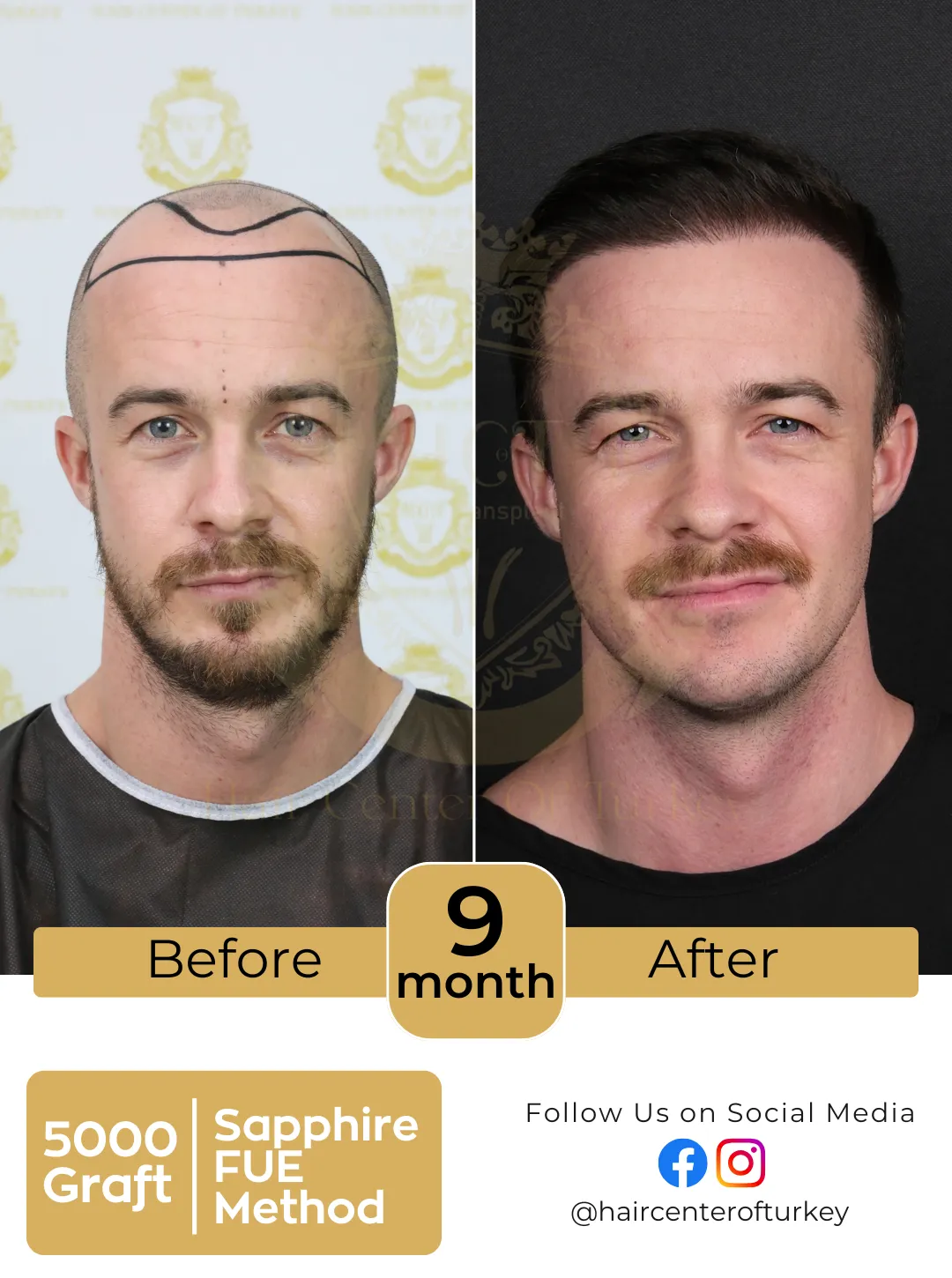 hair transplant before and after images hair center of turkey