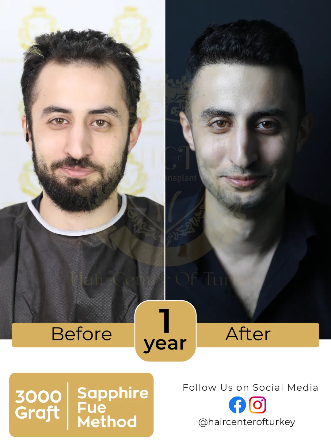 hair transplant before and after images hair center of turkey