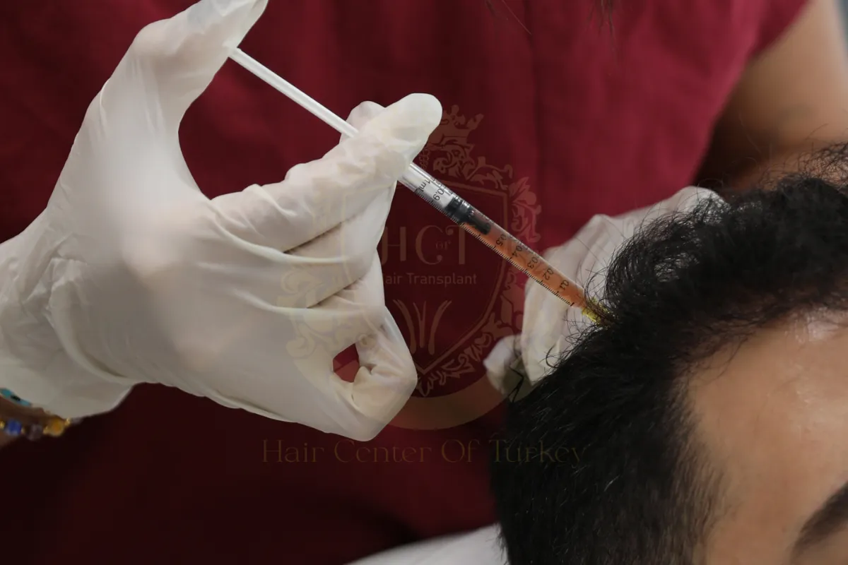 prp for hair loss