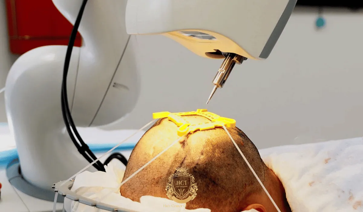 robotic hair transplant