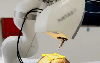 robotic hair transplant