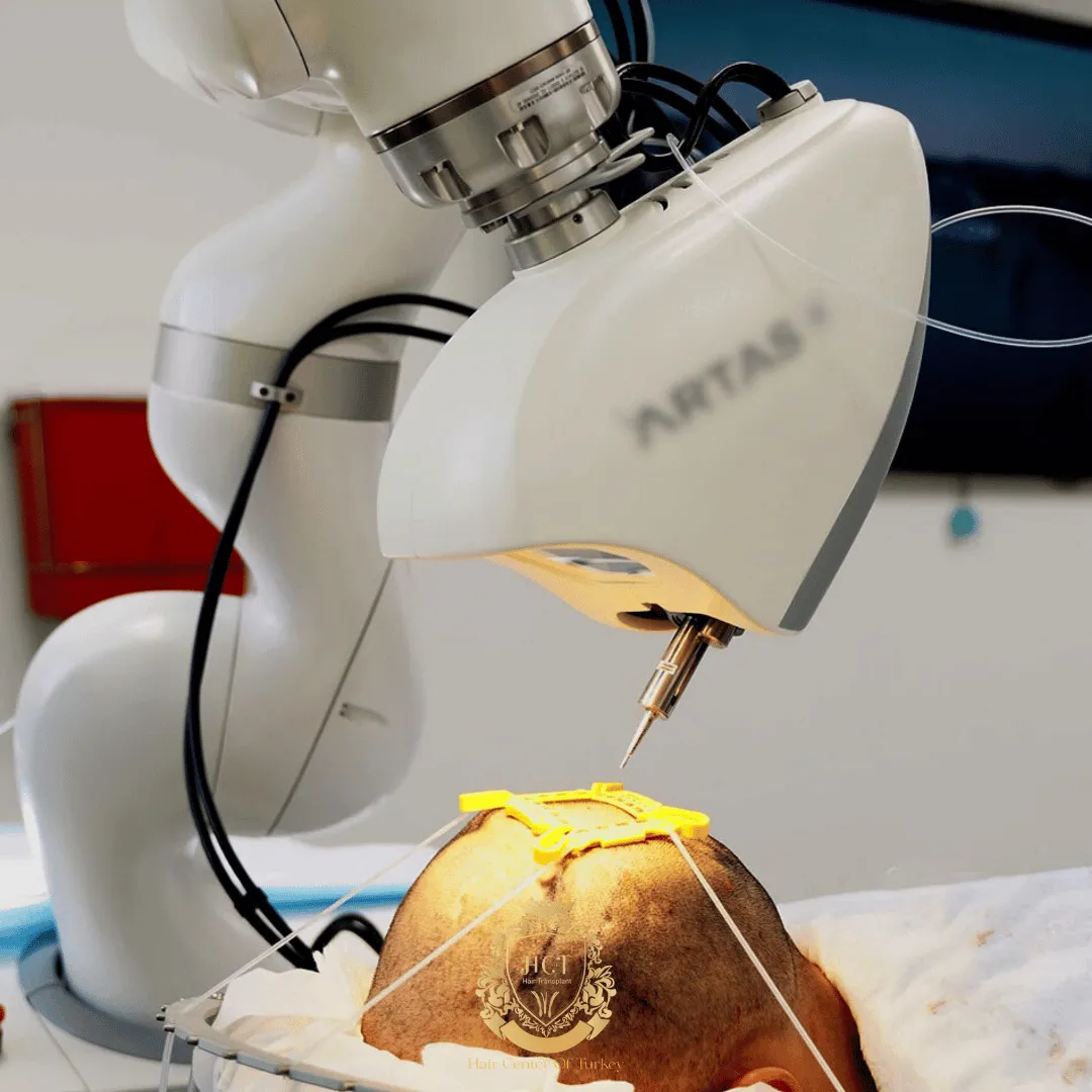 robotic hair transplant