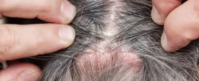 scabs on scalp