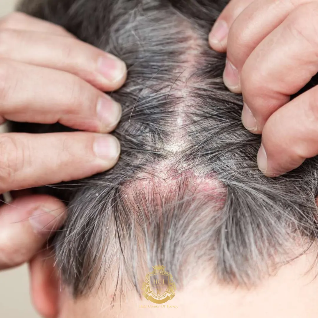 scabs on scalp