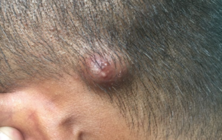 scalp tumor