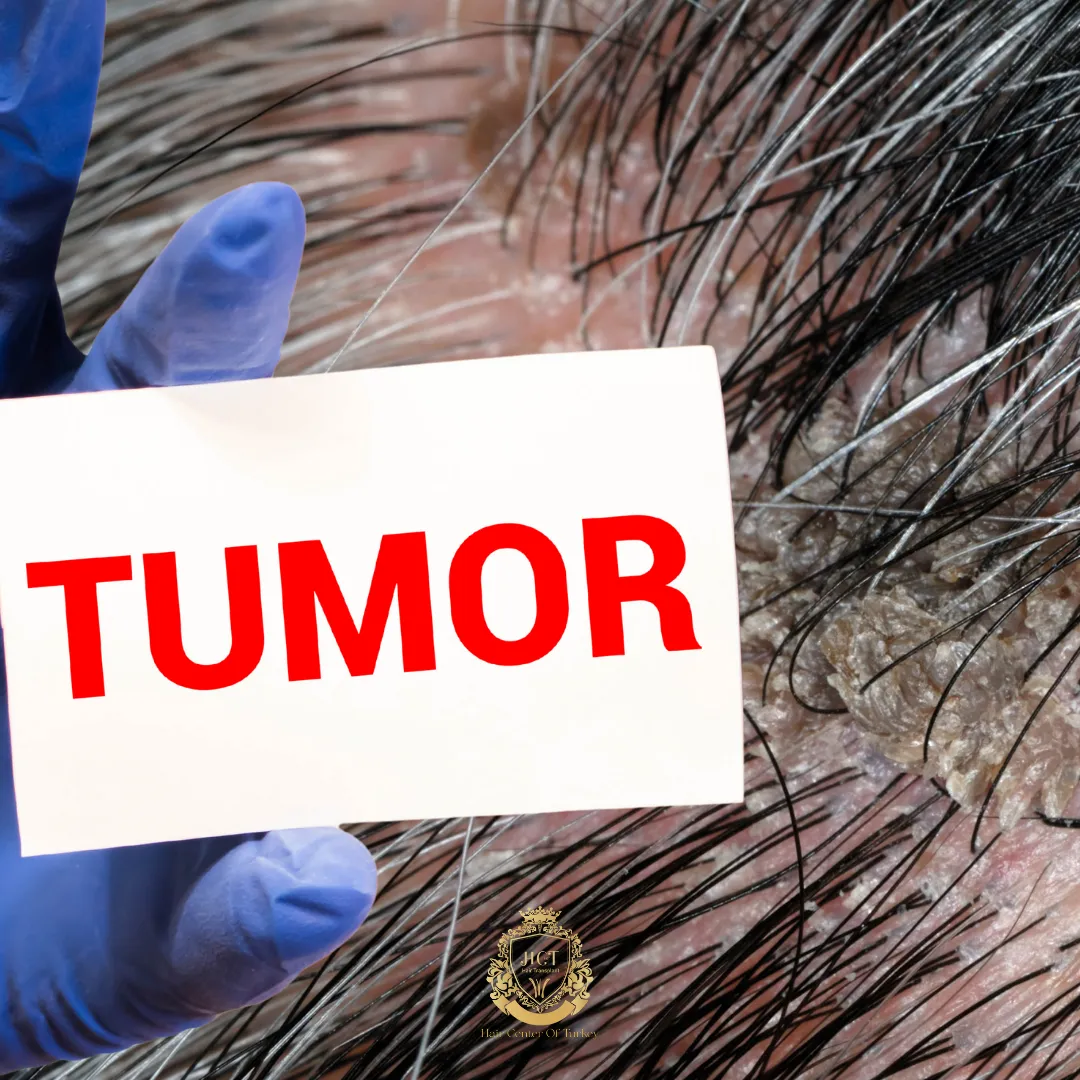 scalp tumors