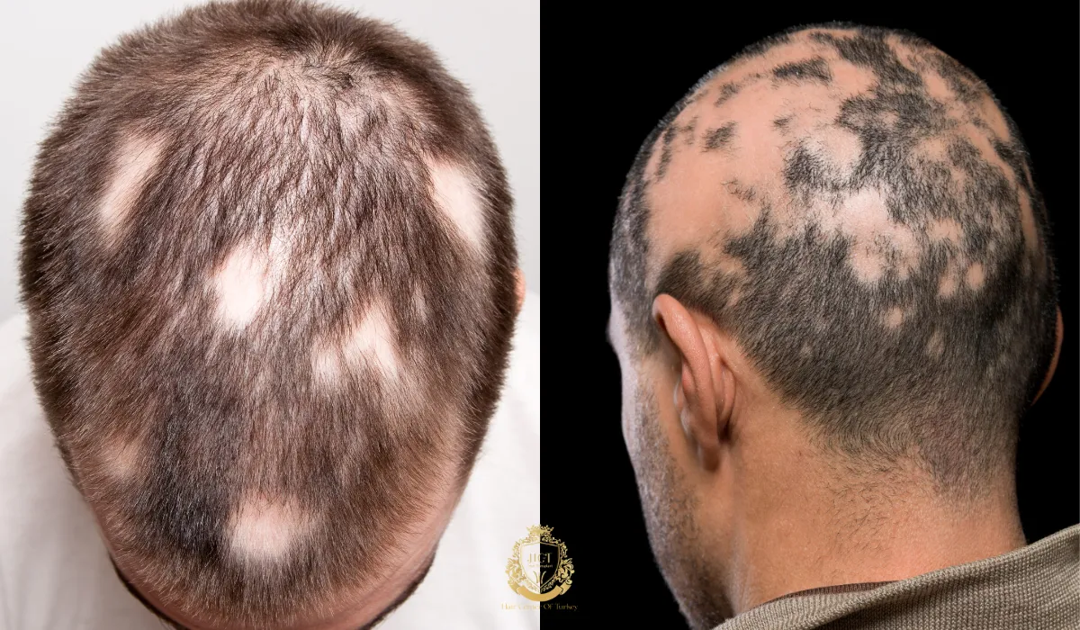 scar alopecia