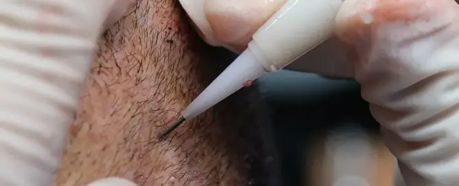 science behind hair  transplant