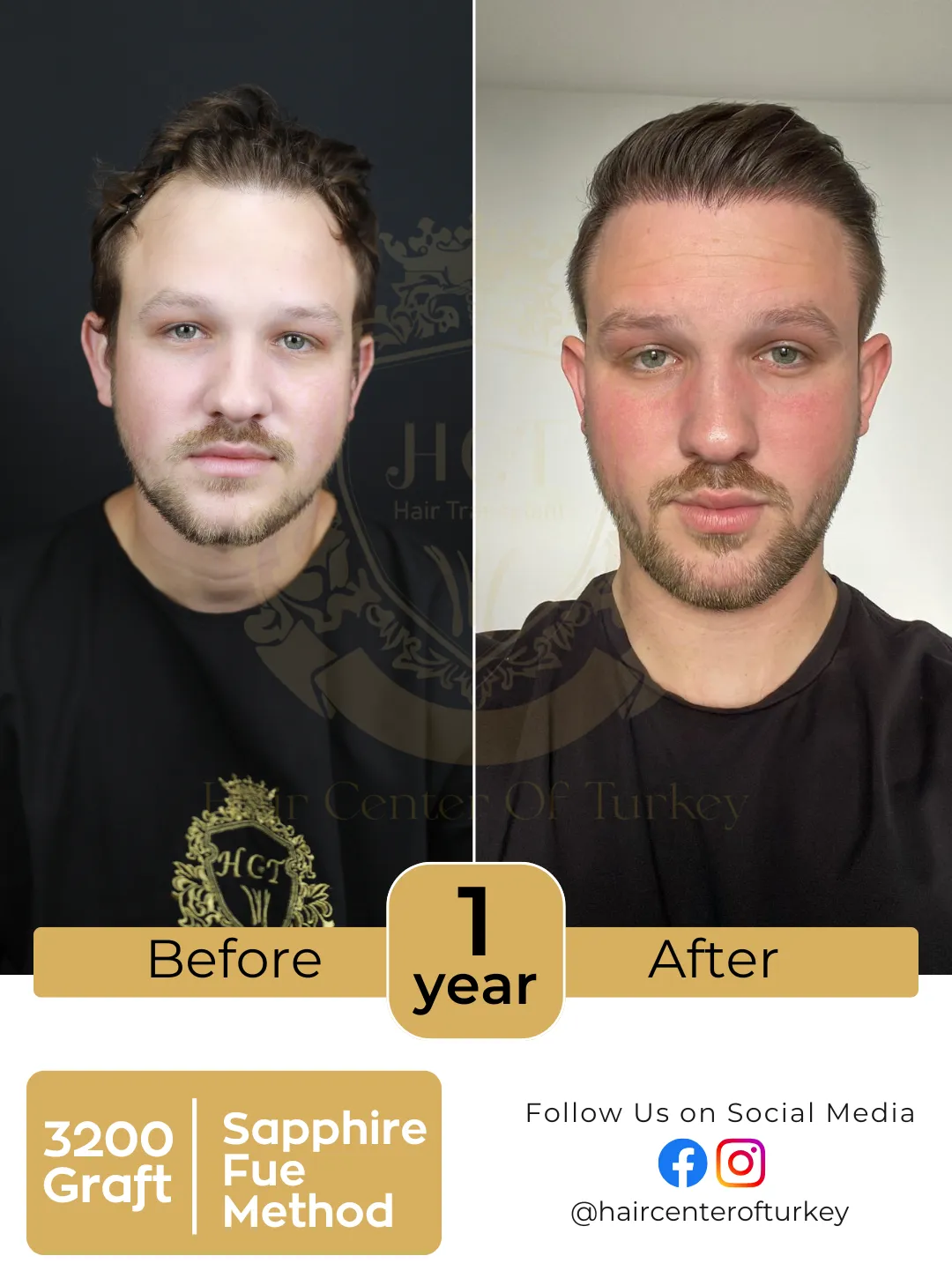 hair transplant before and after images hair center of turkey