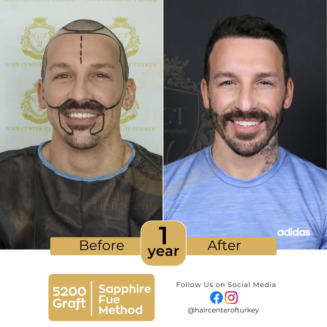 hair transplant before and after images hair center of turkey