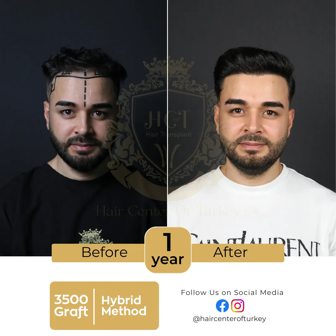 hair transplant before and after images hair center of turkey