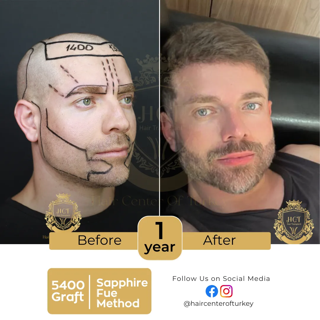 hair transplant before and after images hair center of turkey