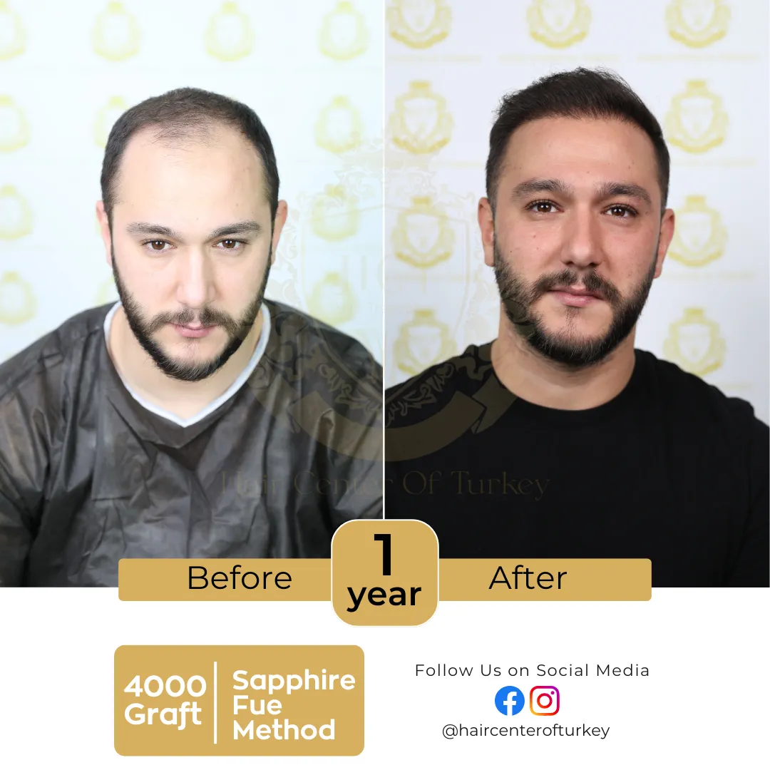 hair transplant before and after images hair center of turkey