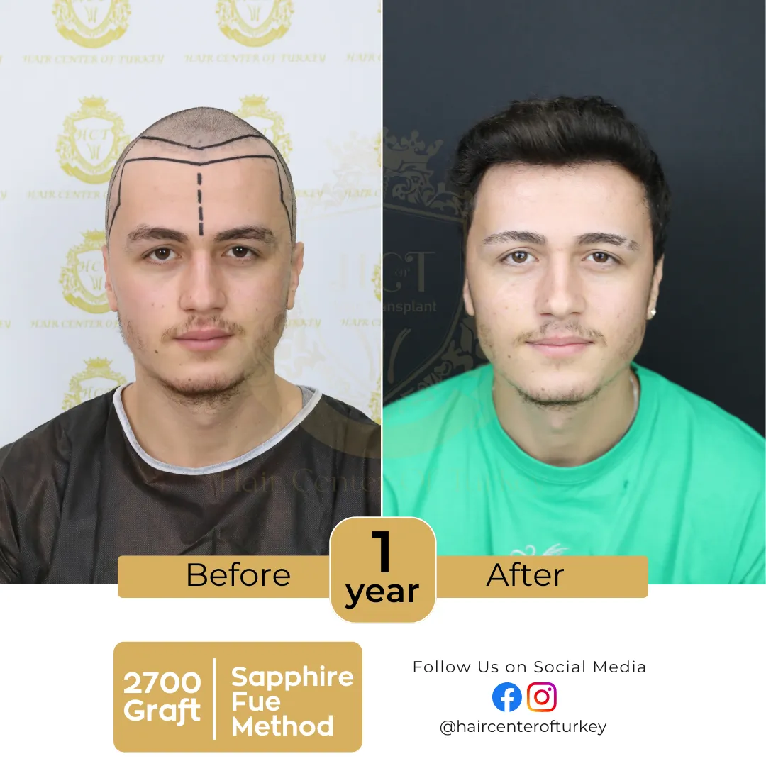 hair transplant before and after images hair center of turkey