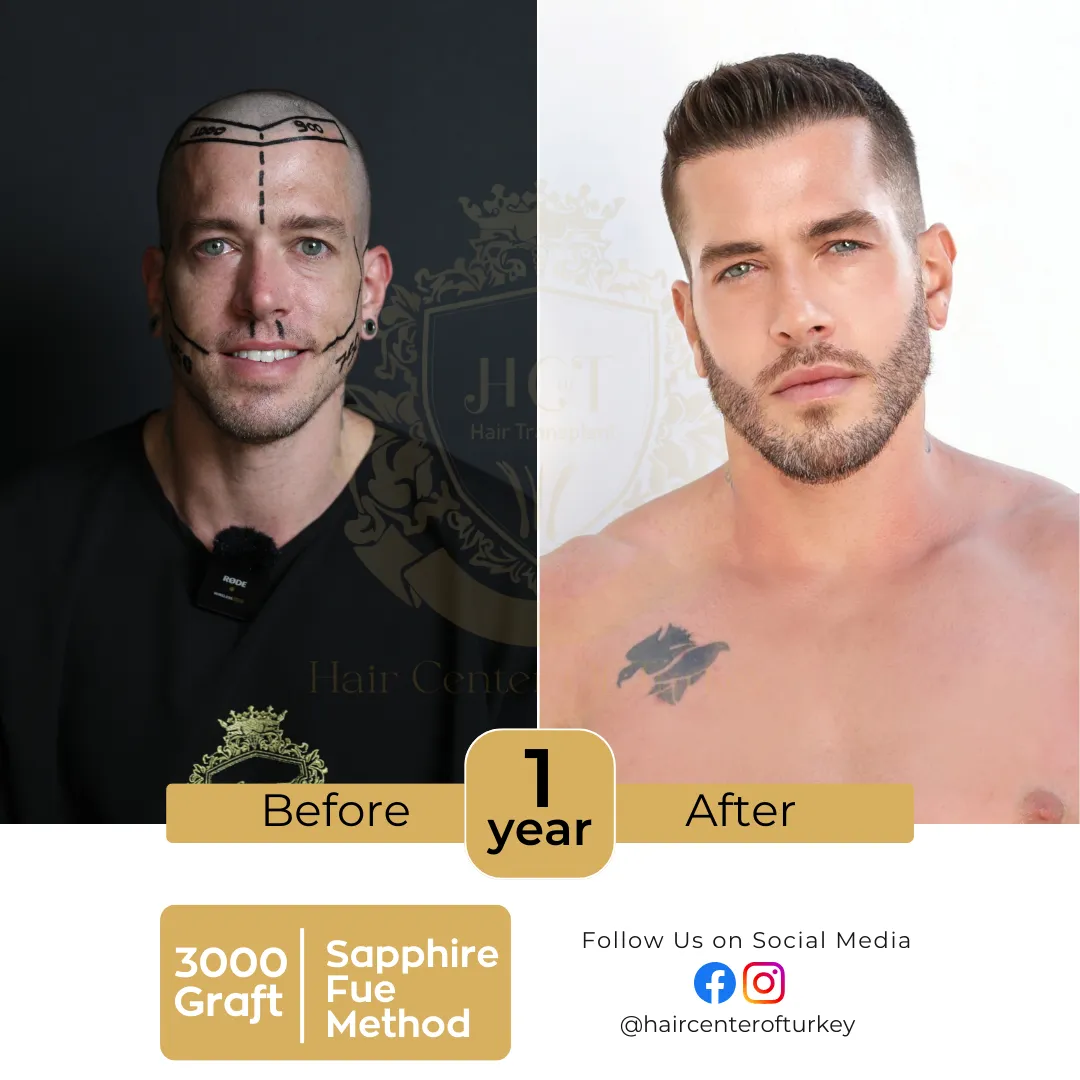 hair transplant before and after images hair center of turkey