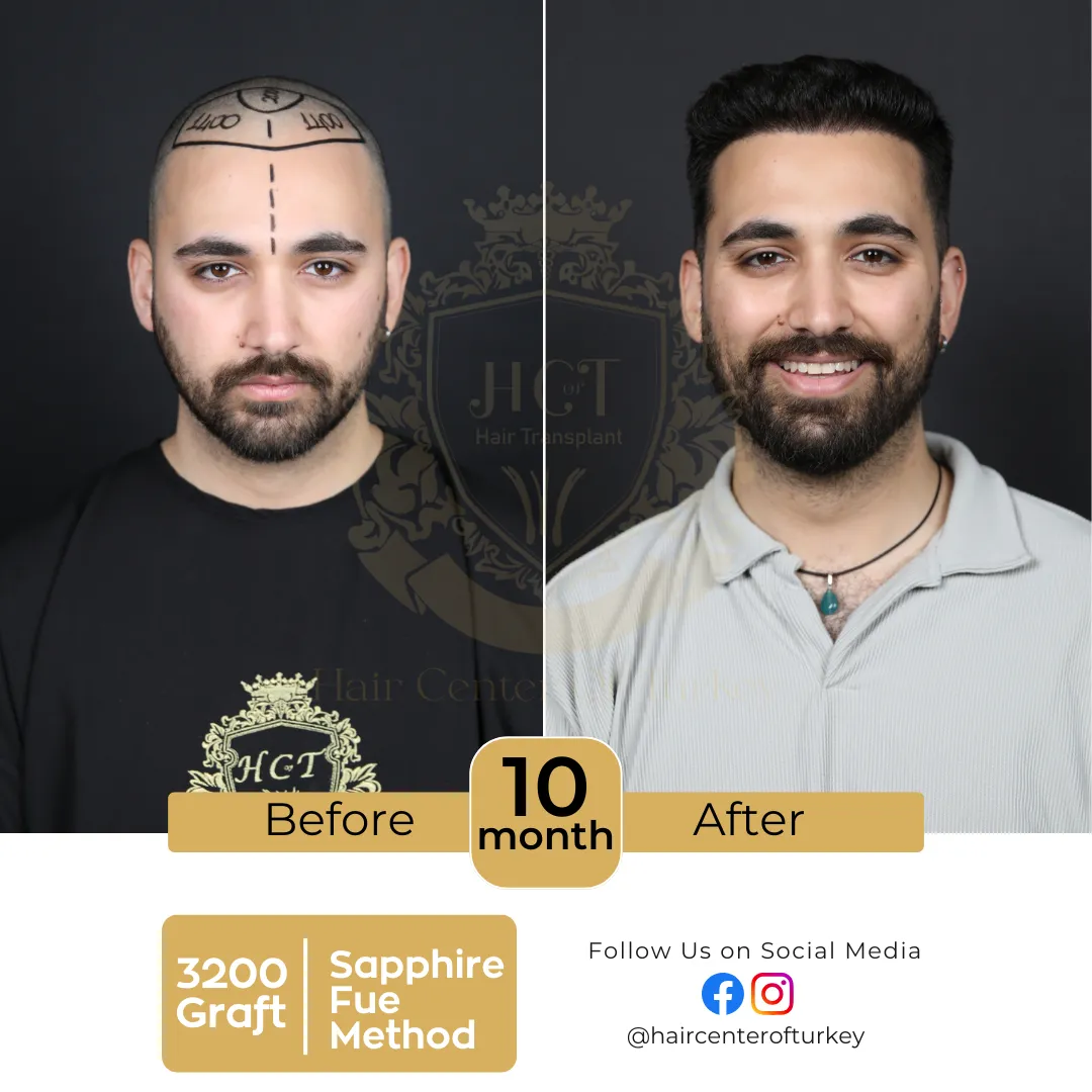 hair transplant before and after images hair center of turkey