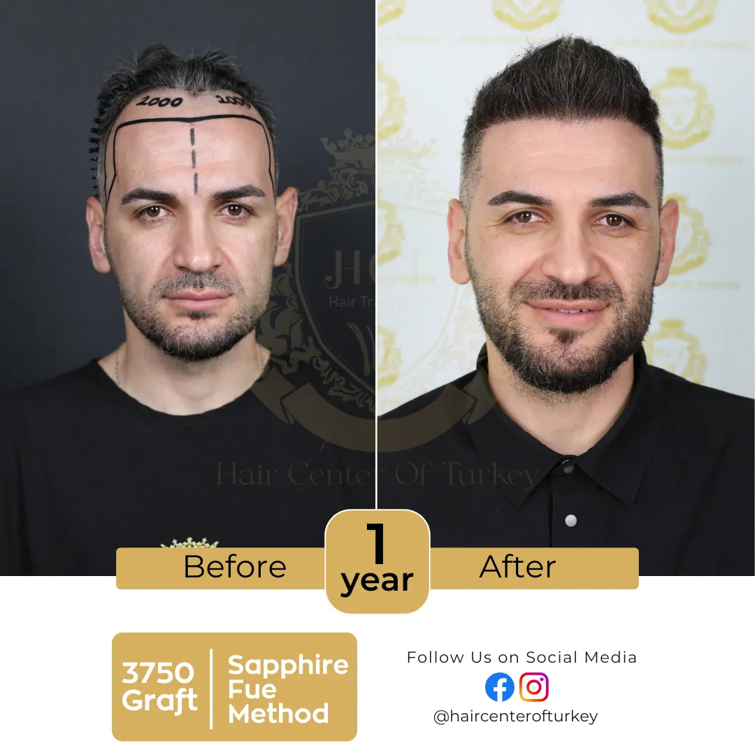 hair transplant before and after images hair center of turkey