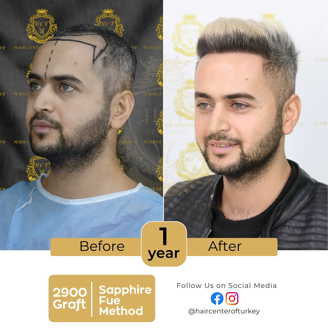 hair transplant before and after images hair center of turkey