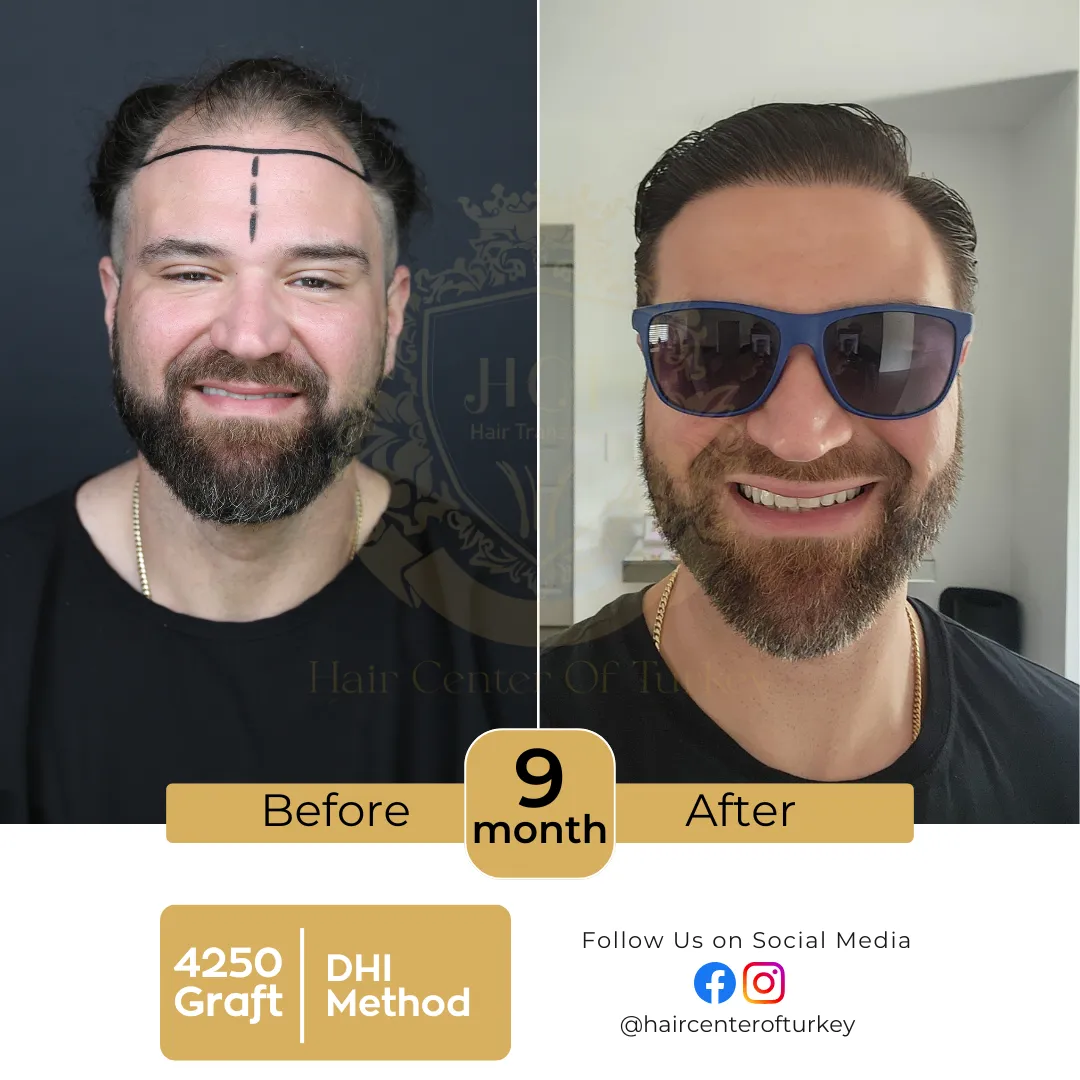 hair transplant before and after images hair center of turkey