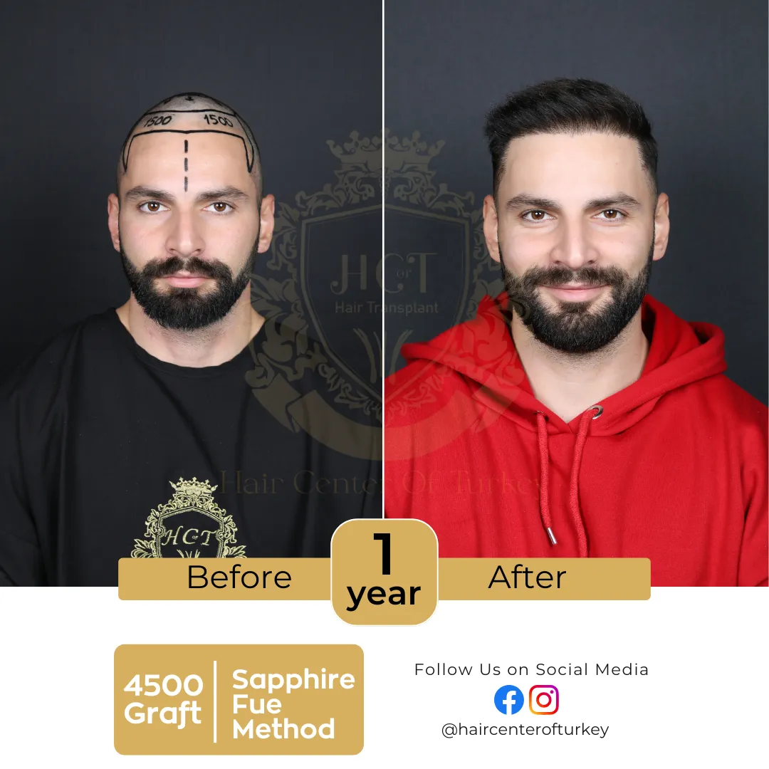 hair transplant before and after images hair center of turkey