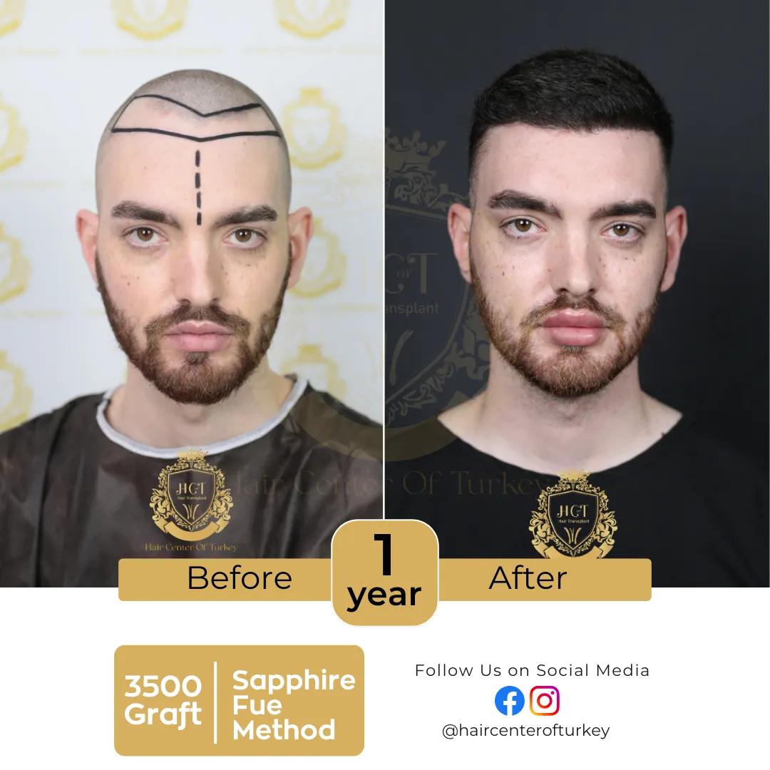 hair transplant before and after images hair center of turkey