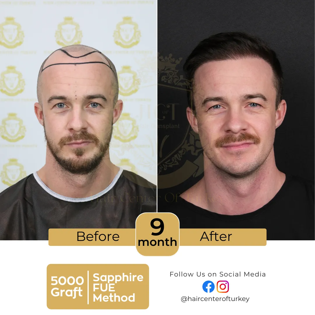 hair transplant before and after images hair center of turkey