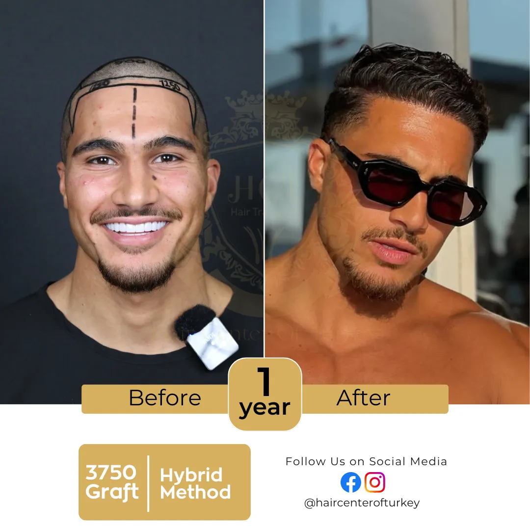 hair transplant before and after images hair center of turkey