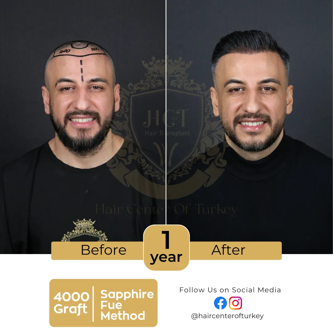 hair transplant before and after images hair center of turkey